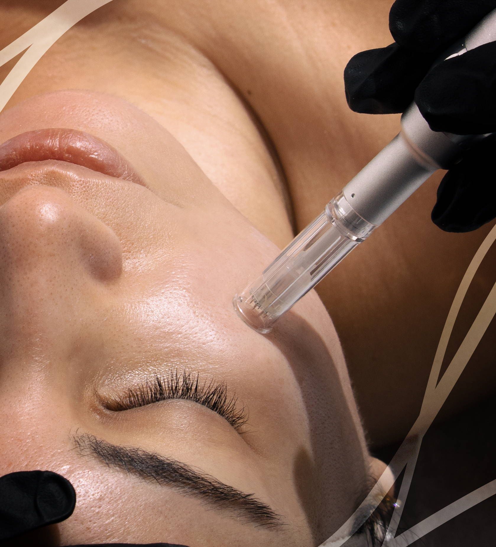 Microneedling-behandling hos Laserklinikcenter Uppsala